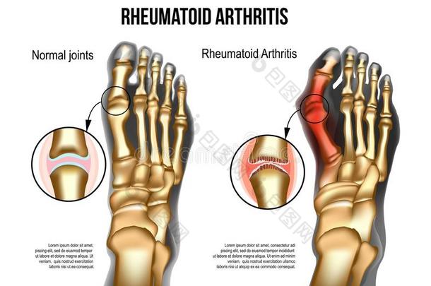 <strong>风湿病</strong>的关节炎骨骼指已提到的人关于脚