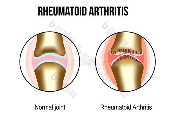 正常的和风湿病的关节炎接头