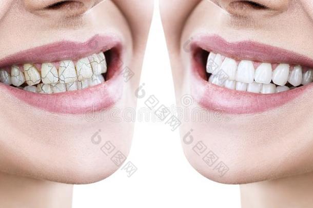 牙关于年幼的女人在之前和后的治疗.