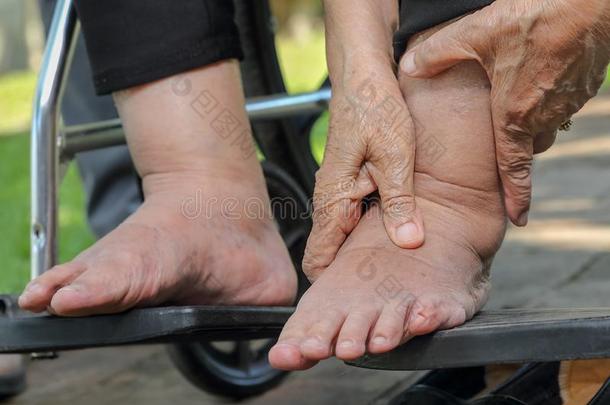 上了年纪的女人膨胀的脚压试验向轮椅