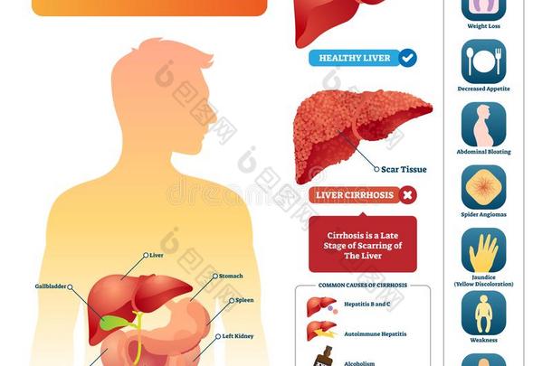 肝硬化矢量说明.标记的医学的图表和伊恩