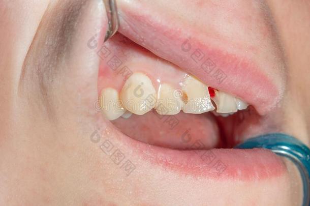 牙齿的龋齿.装满和牙齿的混合成的光敏聚合物物质