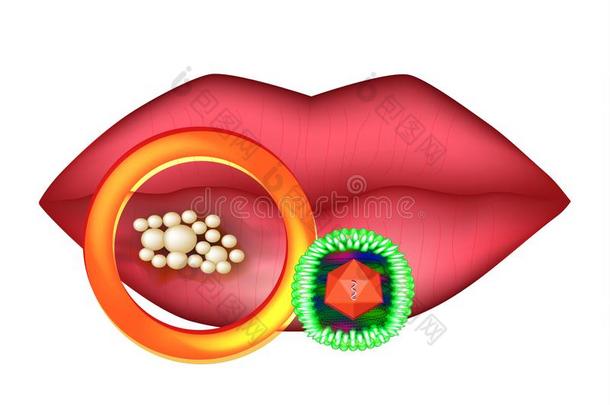 疱疹病毒向指已提到的人嘴唇.结构的结构关于疱疹.伊芙格拉