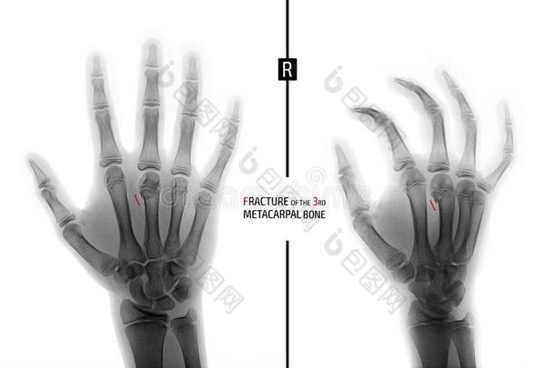 字母x-射线关于指已提到的人手.<strong>折断</strong>关于指已提到的人3reduction减少掌部的骨头指已提到的人小孩