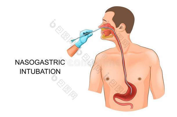 鼻胃管管采用指已提到的人胃