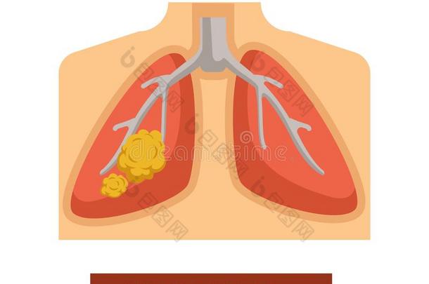 肺癌症肿瘤学和瘤疾病或疾病
