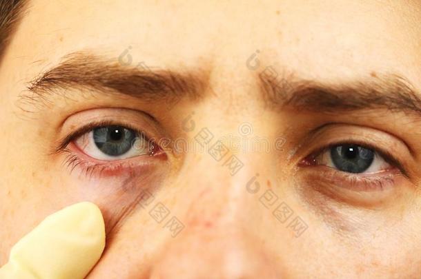 结膜炎,疲倦的眼睛,红色的眼睛,眼睛疾病