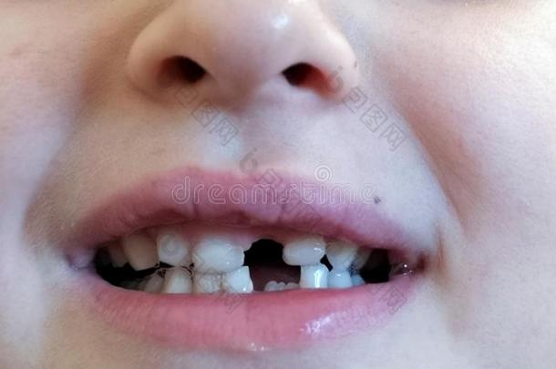 小孩自豪的关于失去的前面牙