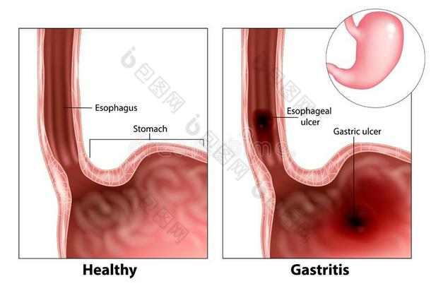 胃炎和食道的溃疡