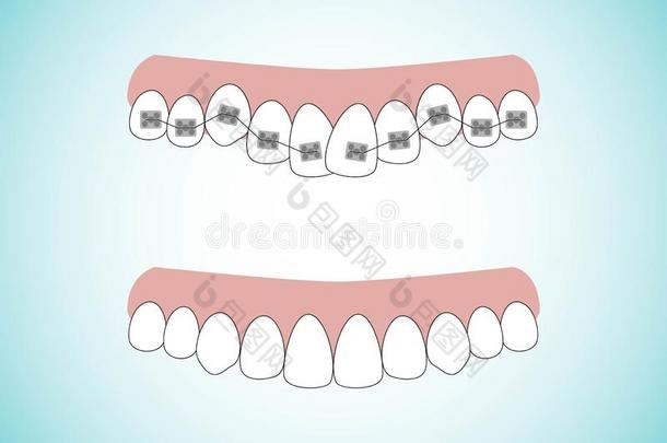 矢量说明关于指已提到的人台关于牙正常的治疗支撑