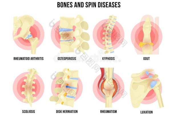 <strong>骨头</strong>和<strong>骨骼</strong>的疾病放置和医学的名字