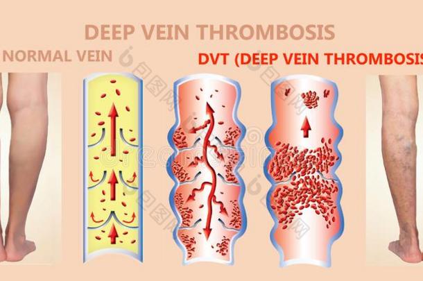 深的静脉血栓症或血凝块.栓子.