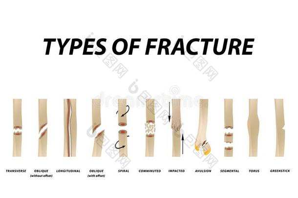 类型关于折断.折断骨头放置.信息图表.矢量图解