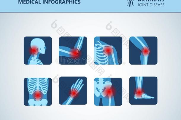 风湿病或风湿病的dis或der医学的放置.关节炎共同的爸