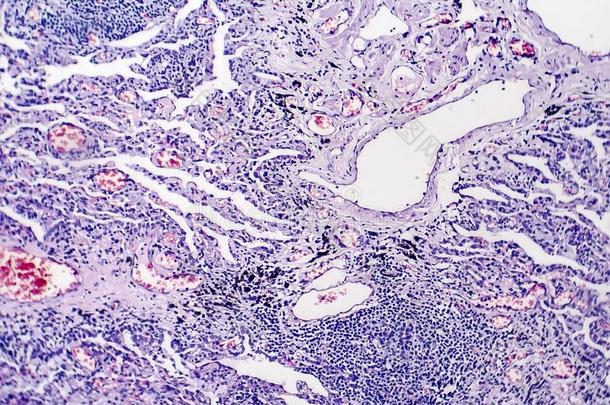 组织病理学说关于肺结核损害