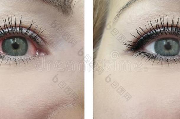 女人红色的眼睛在之前和后的<strong>视力</strong>问题程序ophthalmic眼的