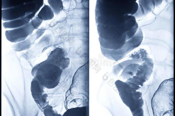 钡灌肠剂影像或字母x-射线影像关于大大地肠或冒号.