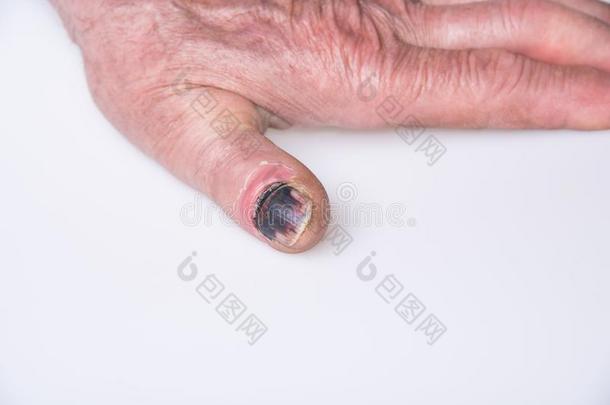 黑的手指钉子从伤害