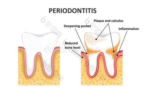 牙周炎,牙齿的疾病.