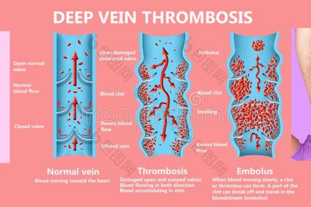 深的静脉血栓症或血凝块.栓子.