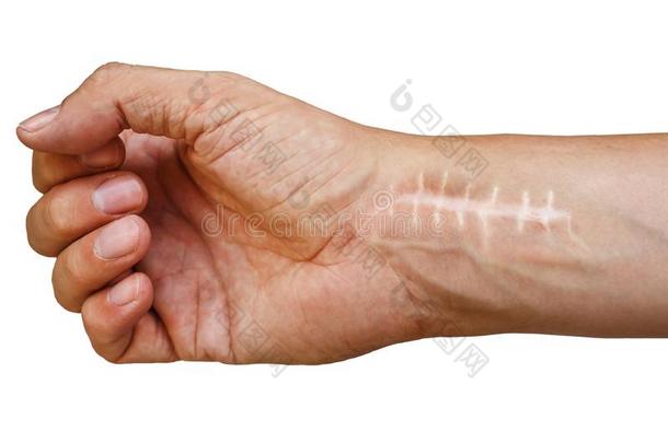 伤<strong>痕</strong>和一针向指已提到的人腕后的外科学.折断关于指已提到的人英语字母表的第2个字母