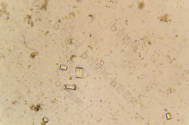 尿水晶,红色的血细胞和粒细胞在指已提到的人显微镜