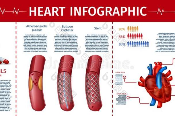 心和心血管的治疗信息图页