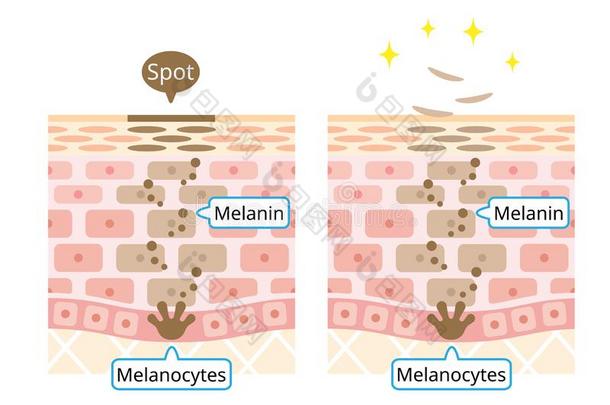 机制关于皮细胞翻滚说明.黑色素和黑变病者