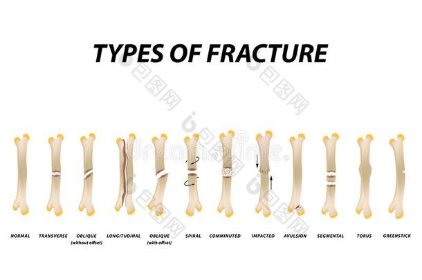 类型关于折断.折断骨头放置.信息图表.矢量图解