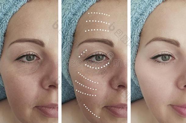 面容女人皮皱纹免职在之前和后的老化cosmetologist美容品业者