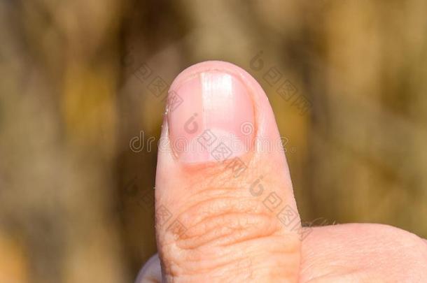 叉状的钉子向指已提到的人拇指.Dilati向关于指已提到的人钉子,外伤的损伤的pathology<strong>病理</strong>学