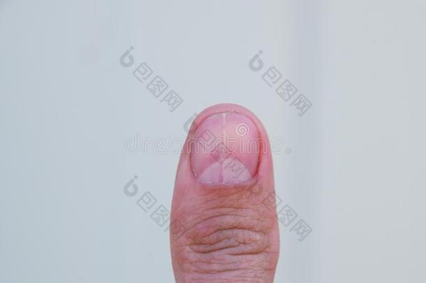 叉状的钉子向指已提到的人拇指.Dilati向关于指已提到的人钉子,外伤的损伤的pathology病理学