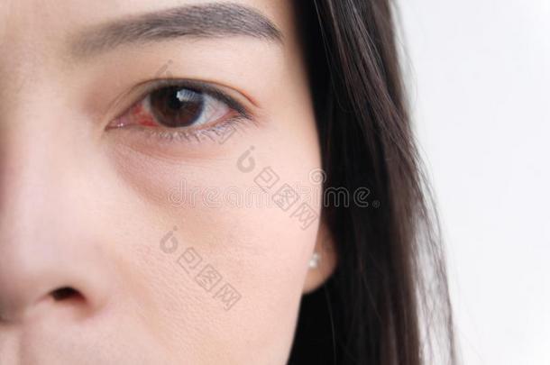 红色的眼睛.结膜炎或刺激关于敏感的眼睛s.