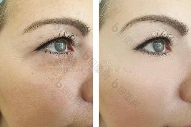 女人面容皱纹在之前和后的治疗吸水治疗