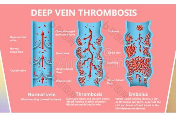 <strong>深</strong>的<strong>静脉血栓</strong>症或血凝块.栓子.