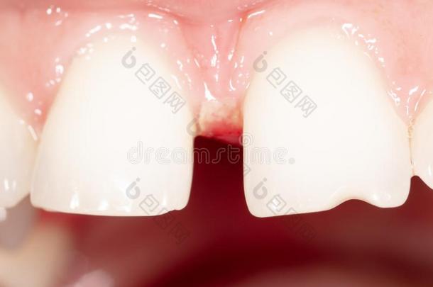 弧形的牙采用一m一n`英文字母表的第19个字母口