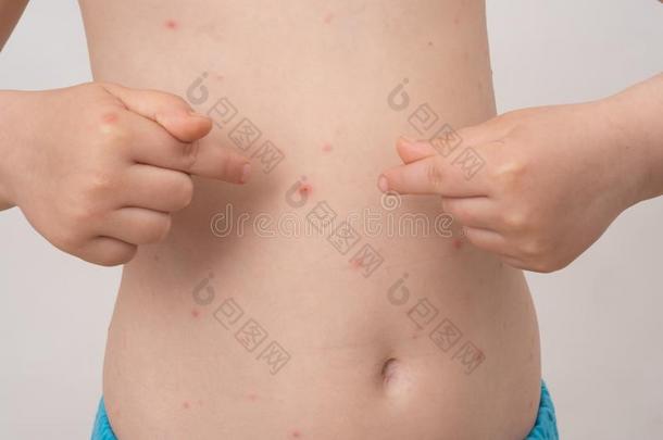 婴儿和鸡发疹的疾病鲁莽的.水痘病毒或Chicken发疹的疾病泡