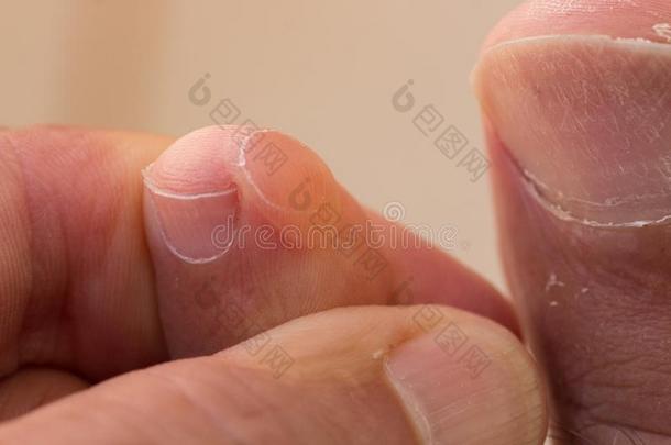 脚趾和大的水疱向指已提到的人面