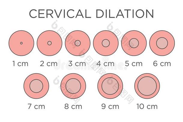 Cervial膨胀医学的说明-图表采用厘米