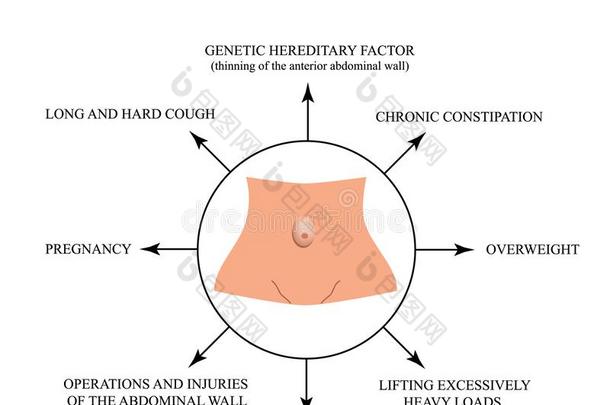 原因关于脐带的疝气.信息图表.矢量说明向
