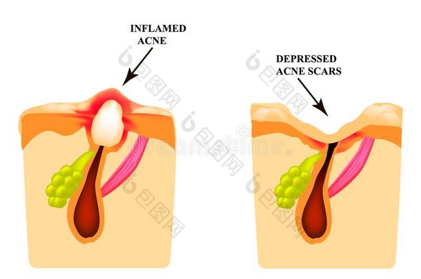 <strong>发炎</strong>的痤疮向指已提到的人皮.<strong>发炎</strong>的丘疹.指已提到的人结构关于指已提到的人