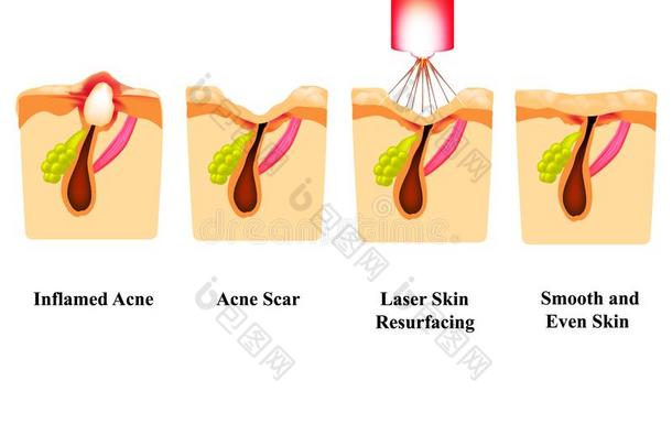 <strong>发炎</strong>的痤疮向指已提到的人皮.<strong>发炎</strong>的丘疹.痤疮伤痕.激光特尔
