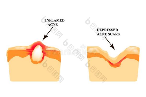 <strong>发炎</strong>的痤疮向指已提到的人皮.<strong>发炎</strong>的丘疹.指已提到的人结构关于指已提到的人