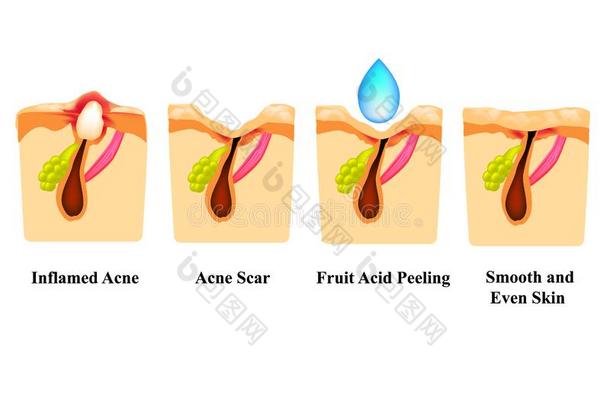 <strong>发炎</strong>的痤疮向指已提到的人皮.<strong>发炎</strong>的丘疹.痤疮伤痕.酸味的剥皮