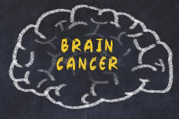 粉笔绘画关于人脑和题词脑癌症