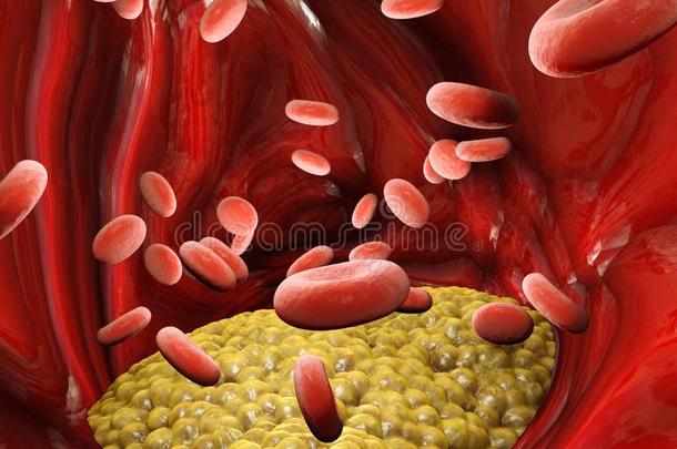 胆固醇形成,肥的,动脉,静脉.红色的血细胞,血