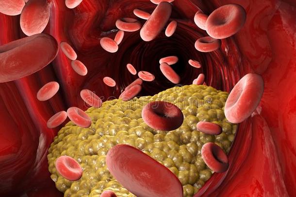 胆固醇形成,肥的,动脉,静脉.红色的血细胞,血