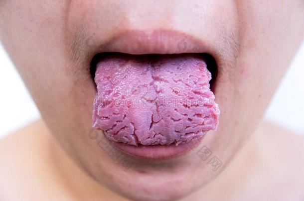 细菌的传染疾病舌头,指已提到的人舌头是（be的三单形式画眉鸟.舌头
