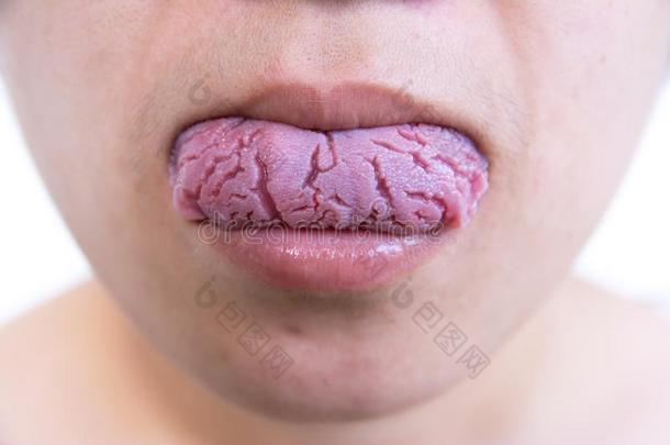 细菌的传染疾病舌头,指已提到的人舌头是（be的三单形式画眉鸟.舌头