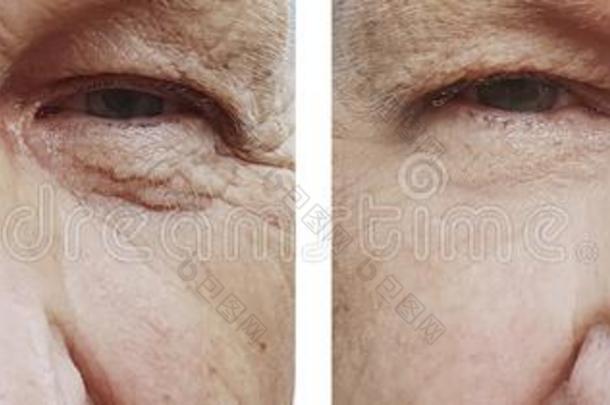 老的男人眼睛皱纹在之前后的治疗返老还童